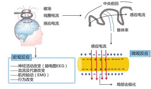 驱散心灵阴霾 重复经颅磁刺激如何重燃帕金森病患者的希望之光